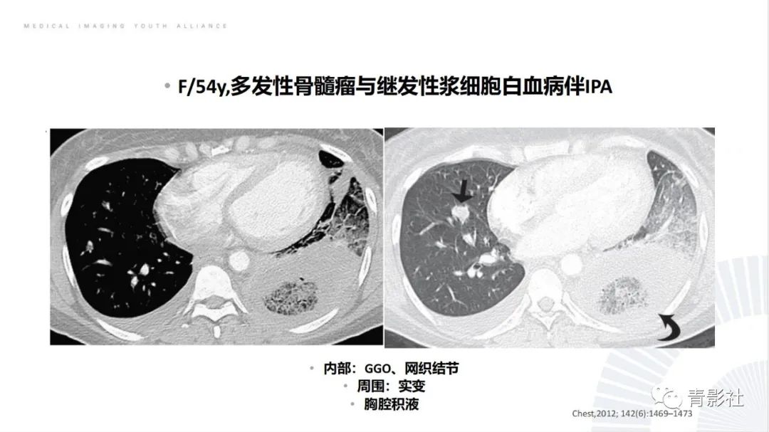 【PPT】肺部反晕征影像诊断思维-38