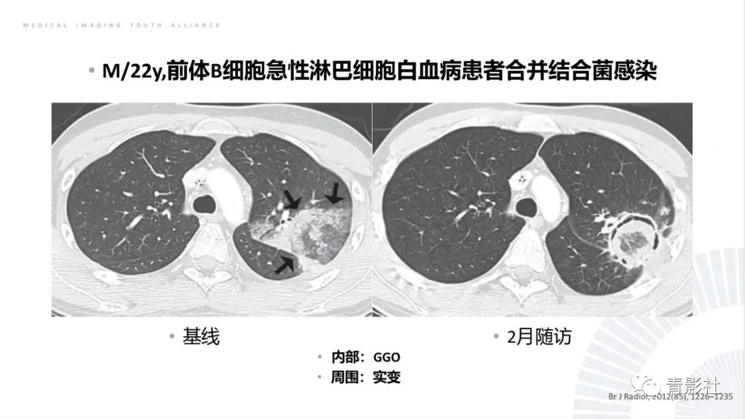 【PPT】肺部反晕征影像诊断思维-37