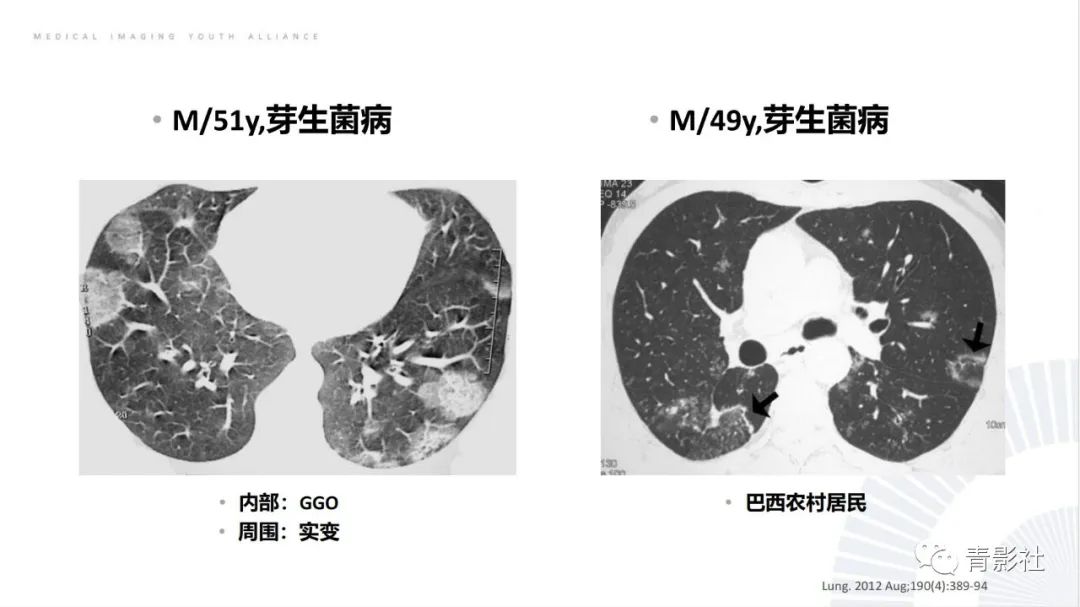 【PPT】肺部反晕征影像诊断思维-40