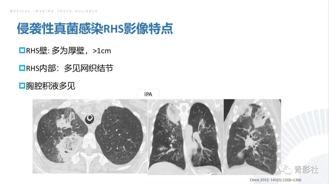 【PPT】肺部反晕征影像诊断思维-41