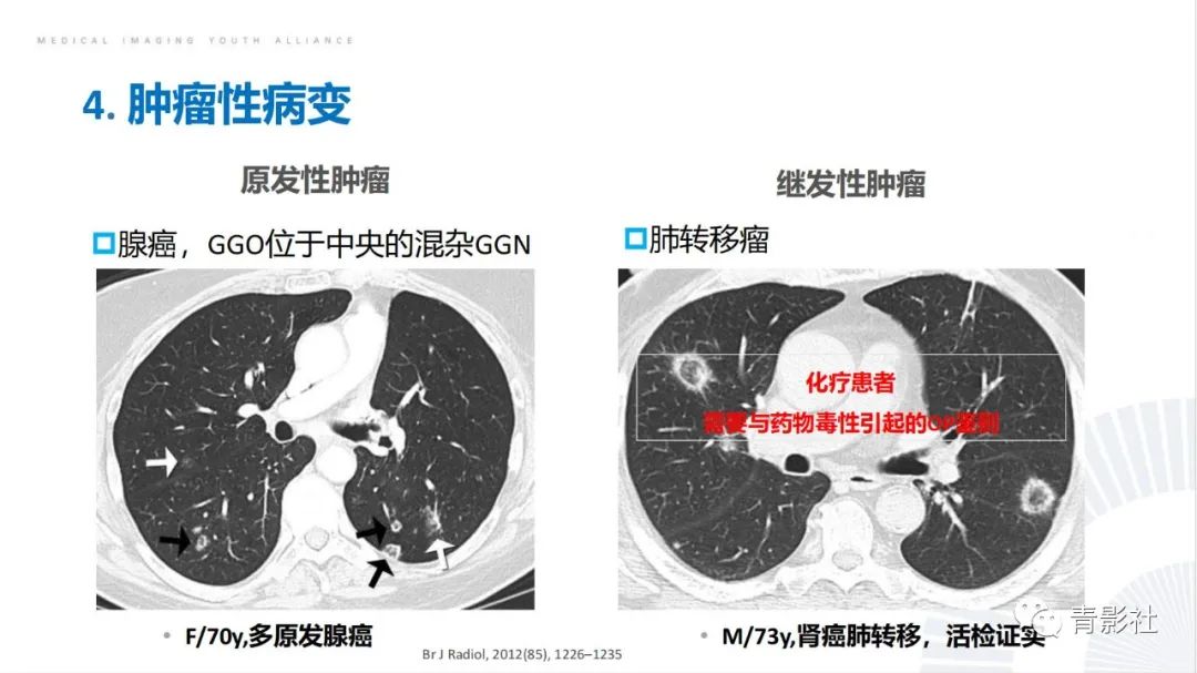 【PPT】肺部反晕征影像诊断思维-42