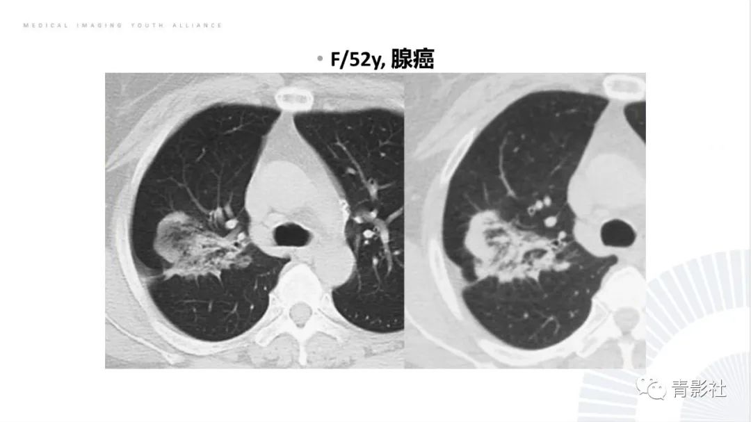 【PPT】肺部反晕征影像诊断思维-43
