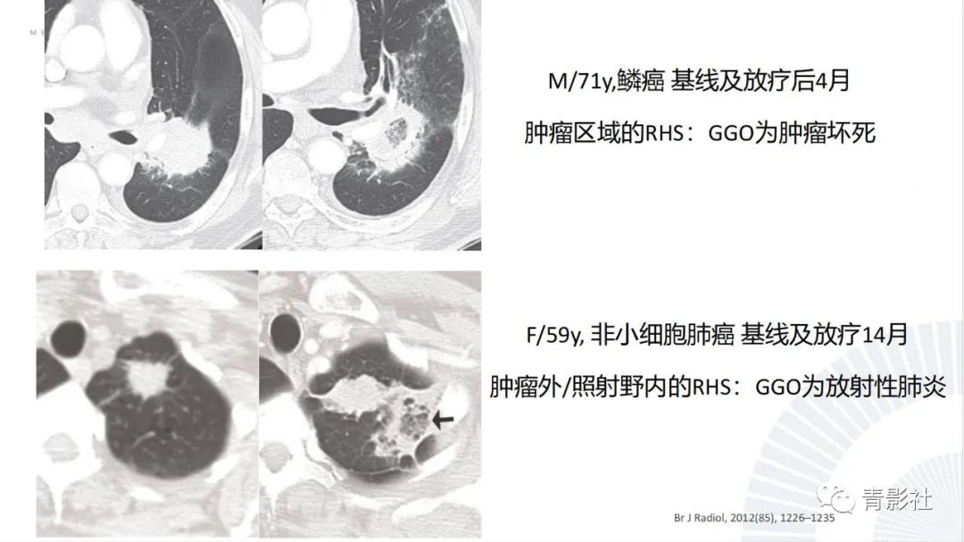 【PPT】肺部反晕征影像诊断思维-46
