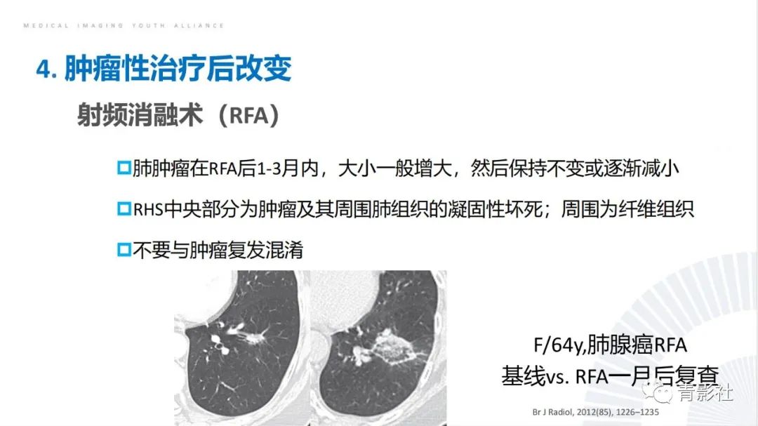 【PPT】肺部反晕征影像诊断思维-44