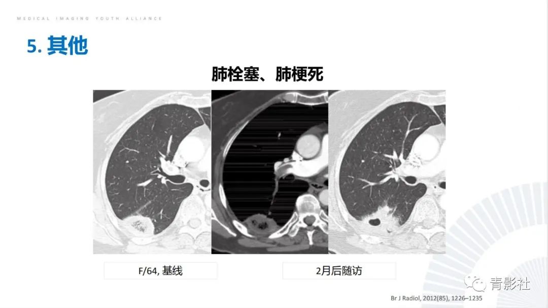 【PPT】肺部反晕征影像诊断思维-47