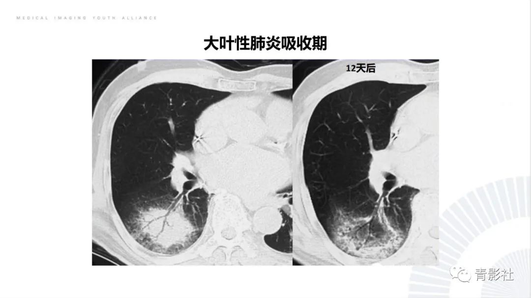 【PPT】肺部反晕征影像诊断思维-48