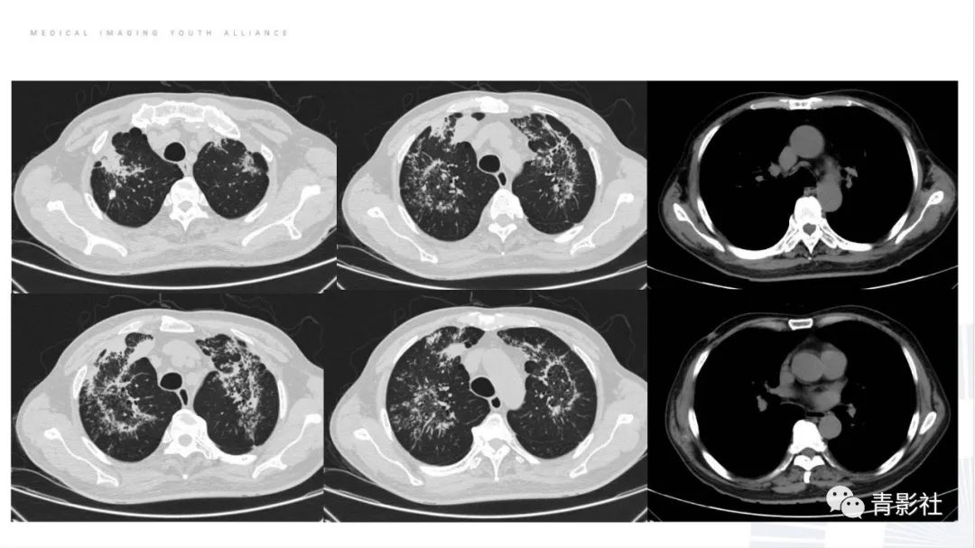 【PPT】肺部反晕征影像诊断思维-52