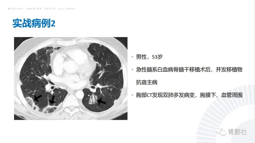 【PPT】肺部反晕征影像诊断思维-54