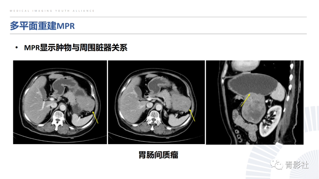 【PPT】左上腹肿块定位诊断思路-5