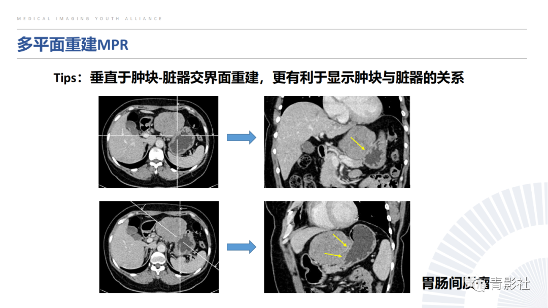 【PPT】左上腹肿块定位诊断思路-6