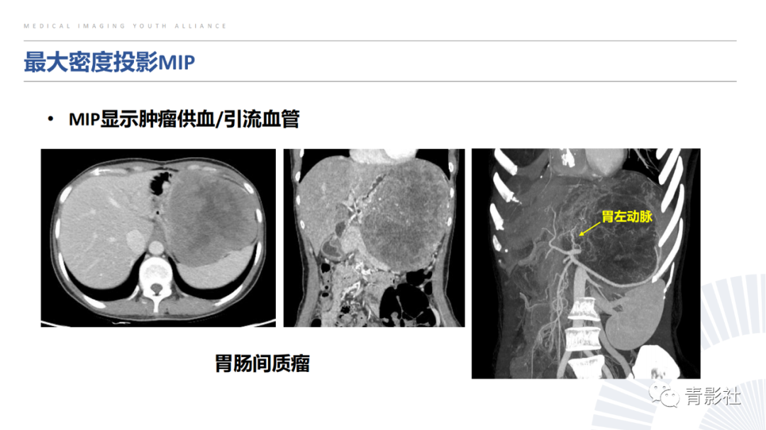 【PPT】左上腹肿块定位诊断思路-7