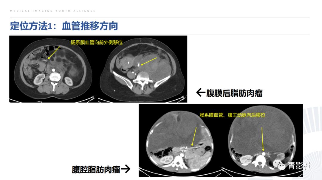 【PPT】左上腹肿块定位诊断思路-12