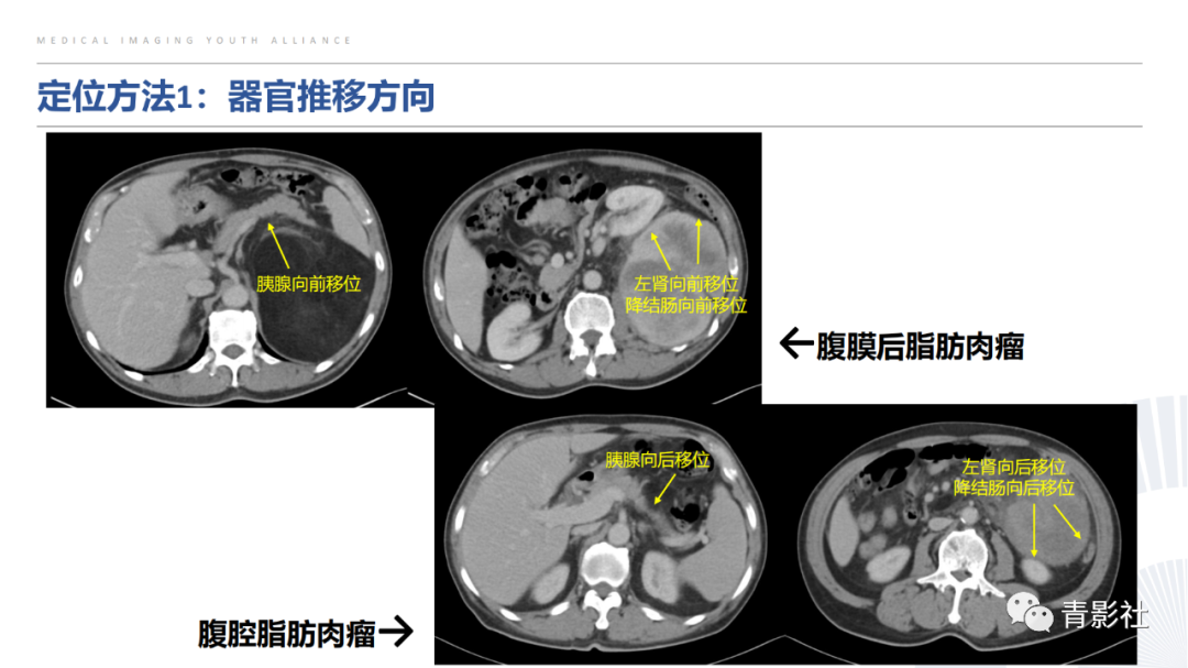 【PPT】左上腹肿块定位诊断思路-11