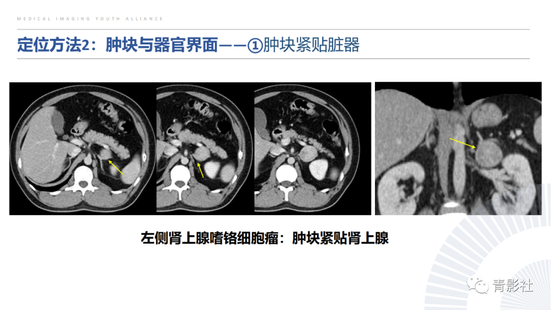 【PPT】左上腹肿块定位诊断思路-14