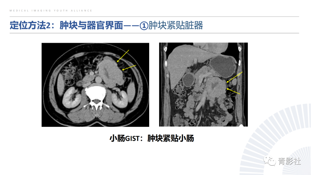 【PPT】左上腹肿块定位诊断思路-15