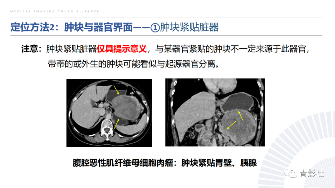 【PPT】左上腹肿块定位诊断思路-16