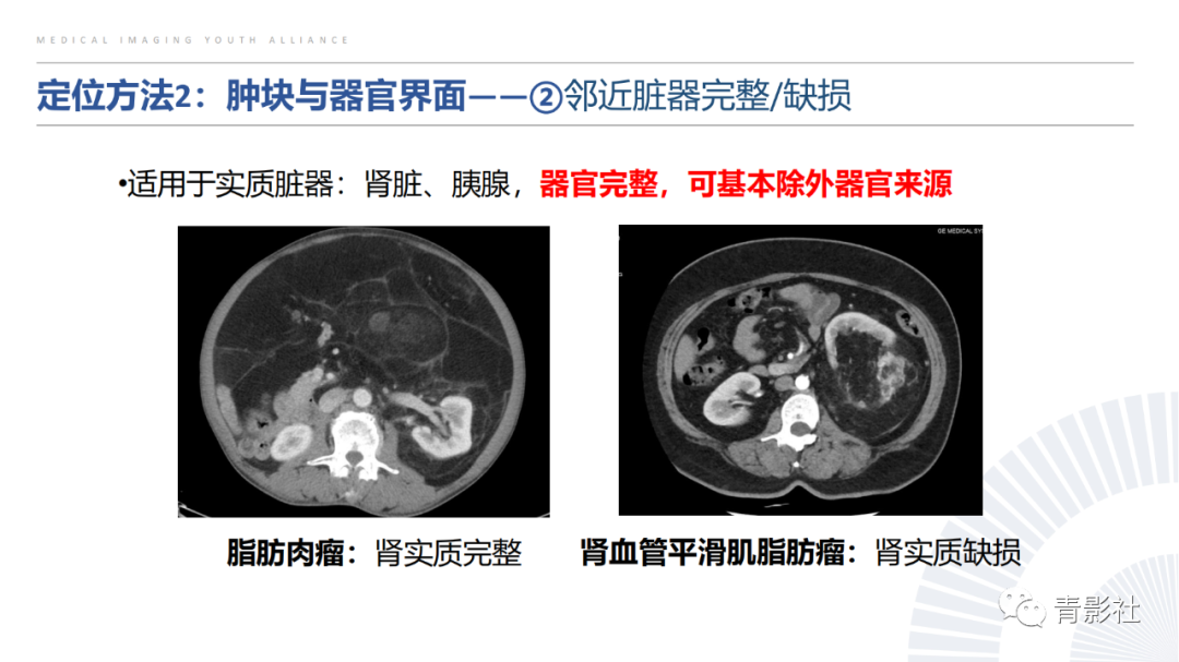 【PPT】左上腹肿块定位诊断思路-18