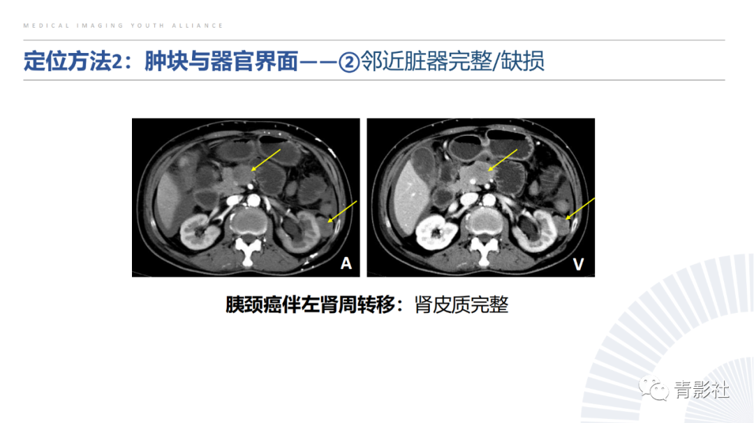 【PPT】左上腹肿块定位诊断思路-19