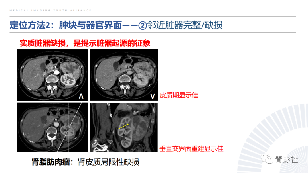 【PPT】左上腹肿块定位诊断思路-20