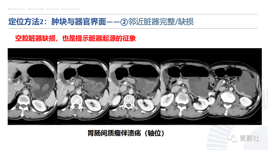 【PPT】左上腹肿块定位诊断思路-21
