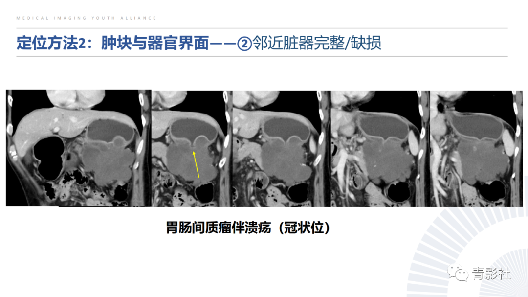 【PPT】左上腹肿块定位诊断思路-22