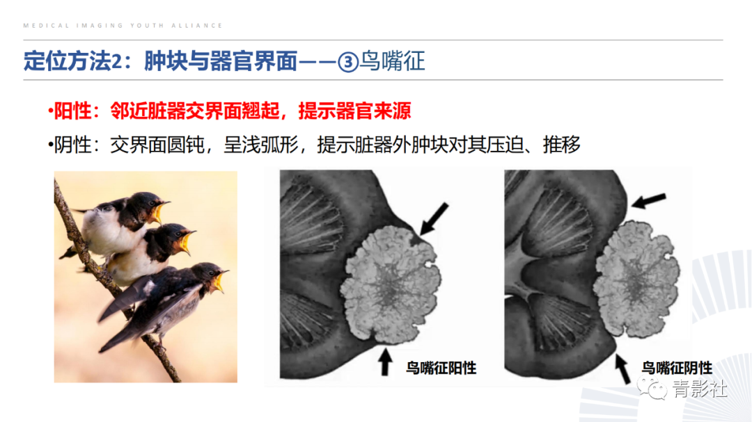 【PPT】左上腹肿块定位诊断思路-23