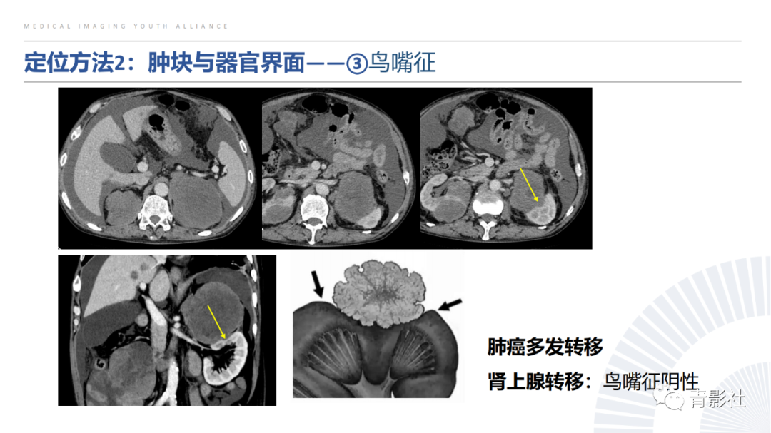 【PPT】左上腹肿块定位诊断思路-26
