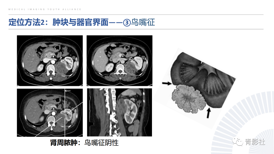 【PPT】左上腹肿块定位诊断思路-25
