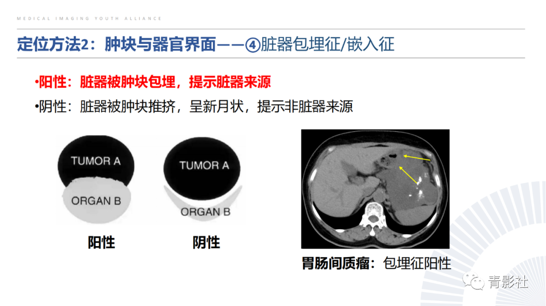 【PPT】左上腹肿块定位诊断思路-27