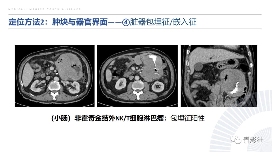 【PPT】左上腹肿块定位诊断思路-28