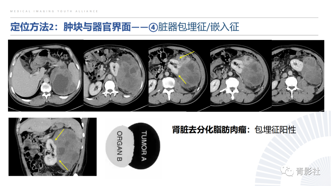 【PPT】左上腹肿块定位诊断思路-29