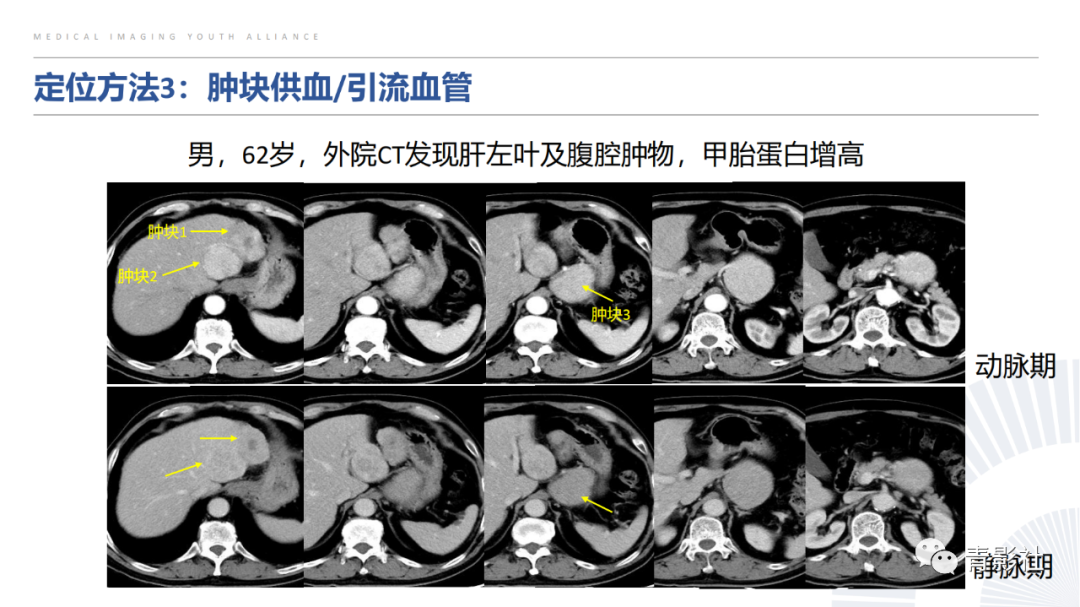 【PPT】左上腹肿块定位诊断思路-32