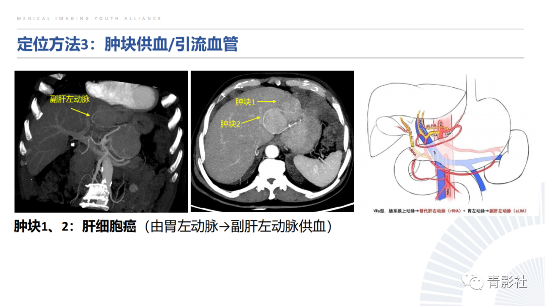 【PPT】左上腹肿块定位诊断思路-33