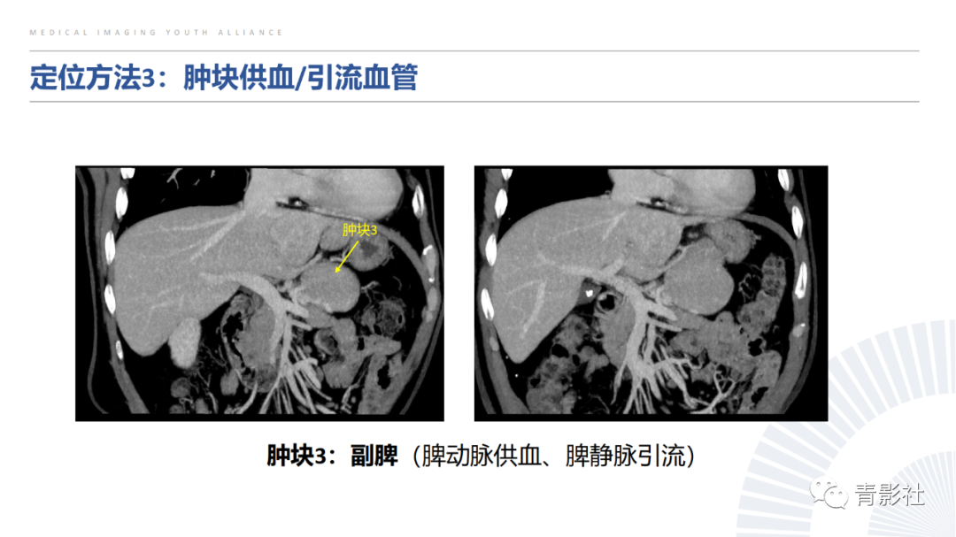 【PPT】左上腹肿块定位诊断思路-34