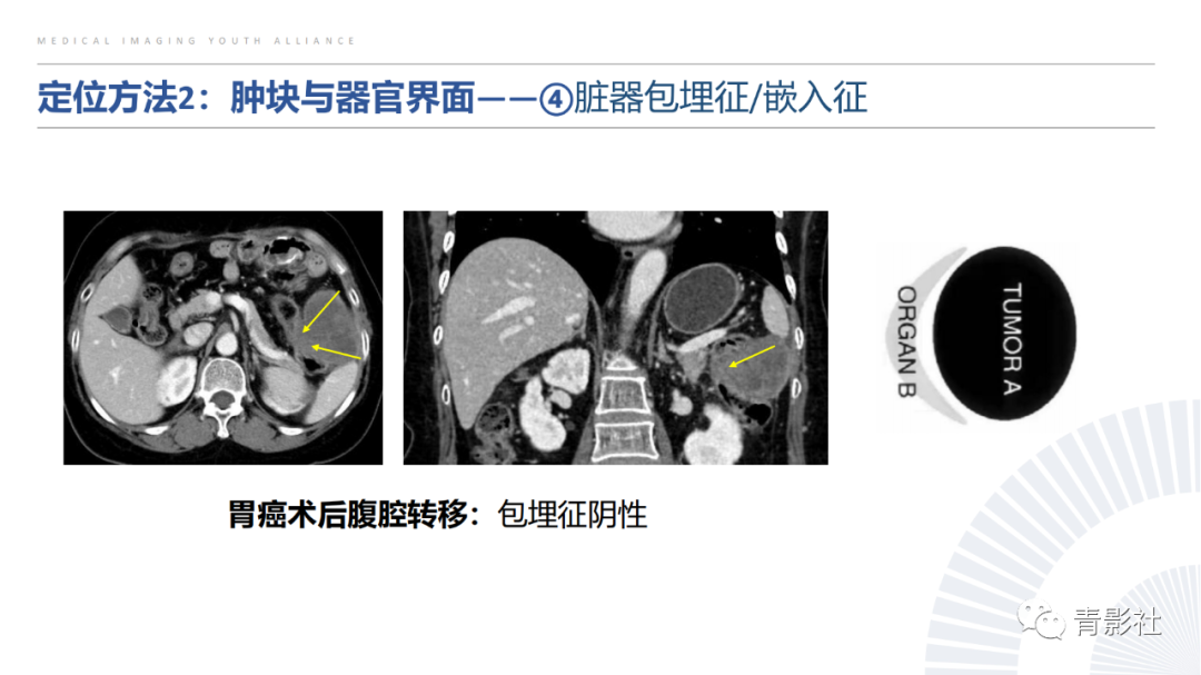 【PPT】左上腹肿块定位诊断思路-30