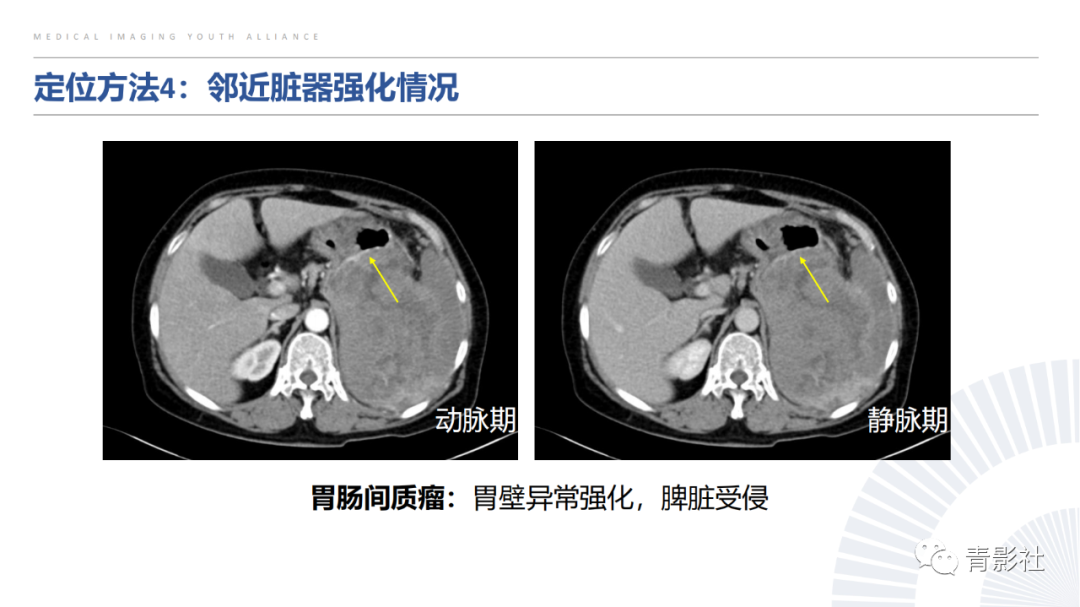 【PPT】左上腹肿块定位诊断思路-36