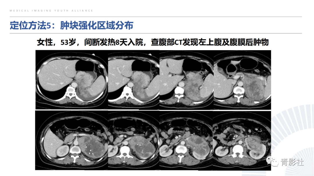 【PPT】左上腹肿块定位诊断思路-37