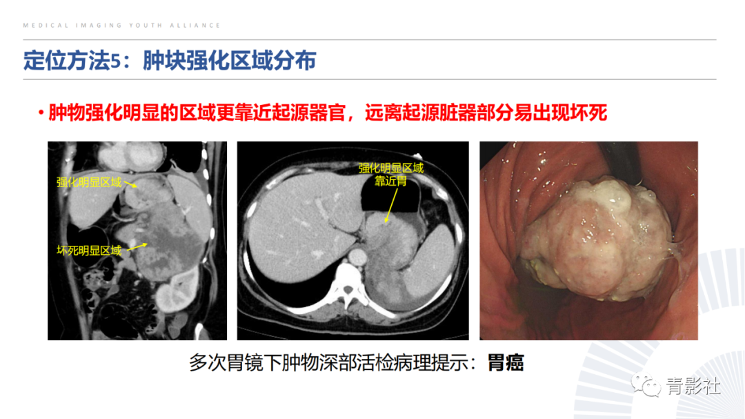 【PPT】左上腹肿块定位诊断思路-38