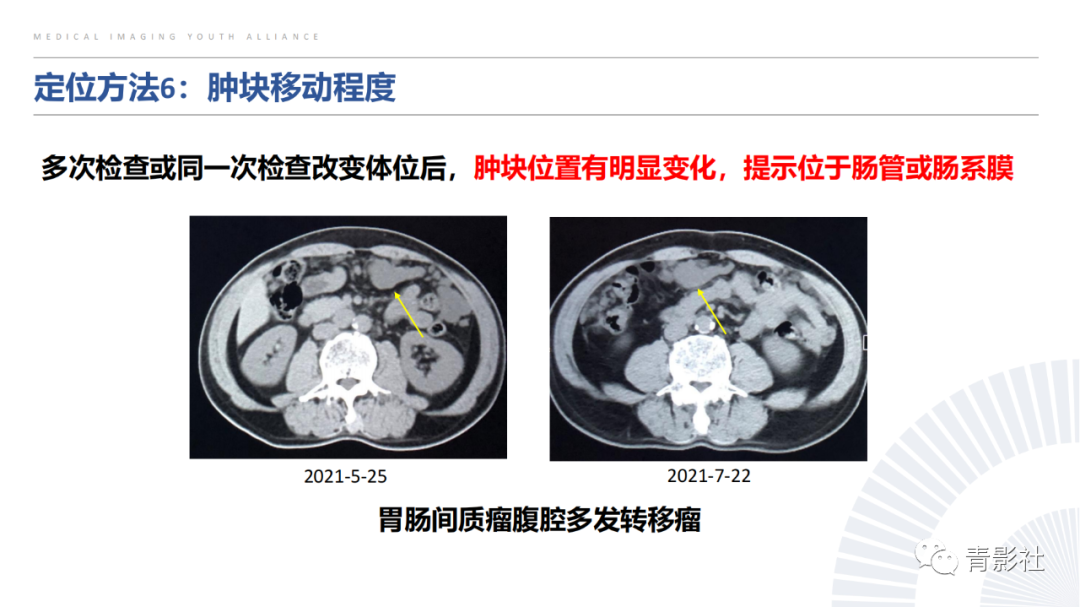 【PPT】左上腹肿块定位诊断思路-39