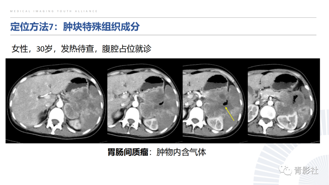【PPT】左上腹肿块定位诊断思路-42