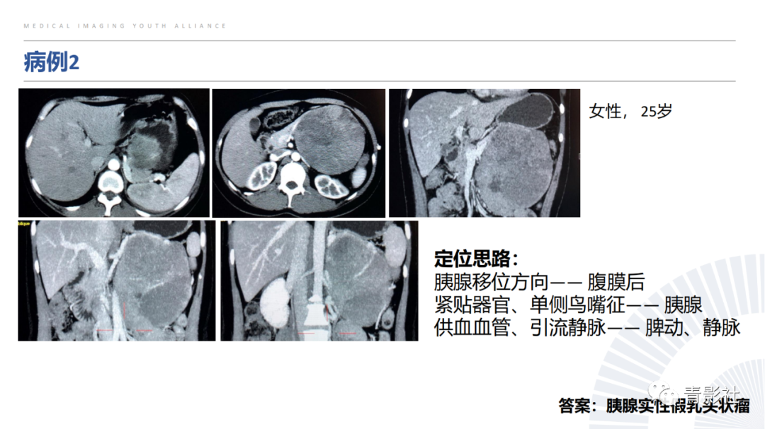 【PPT】左上腹肿块定位诊断思路-46