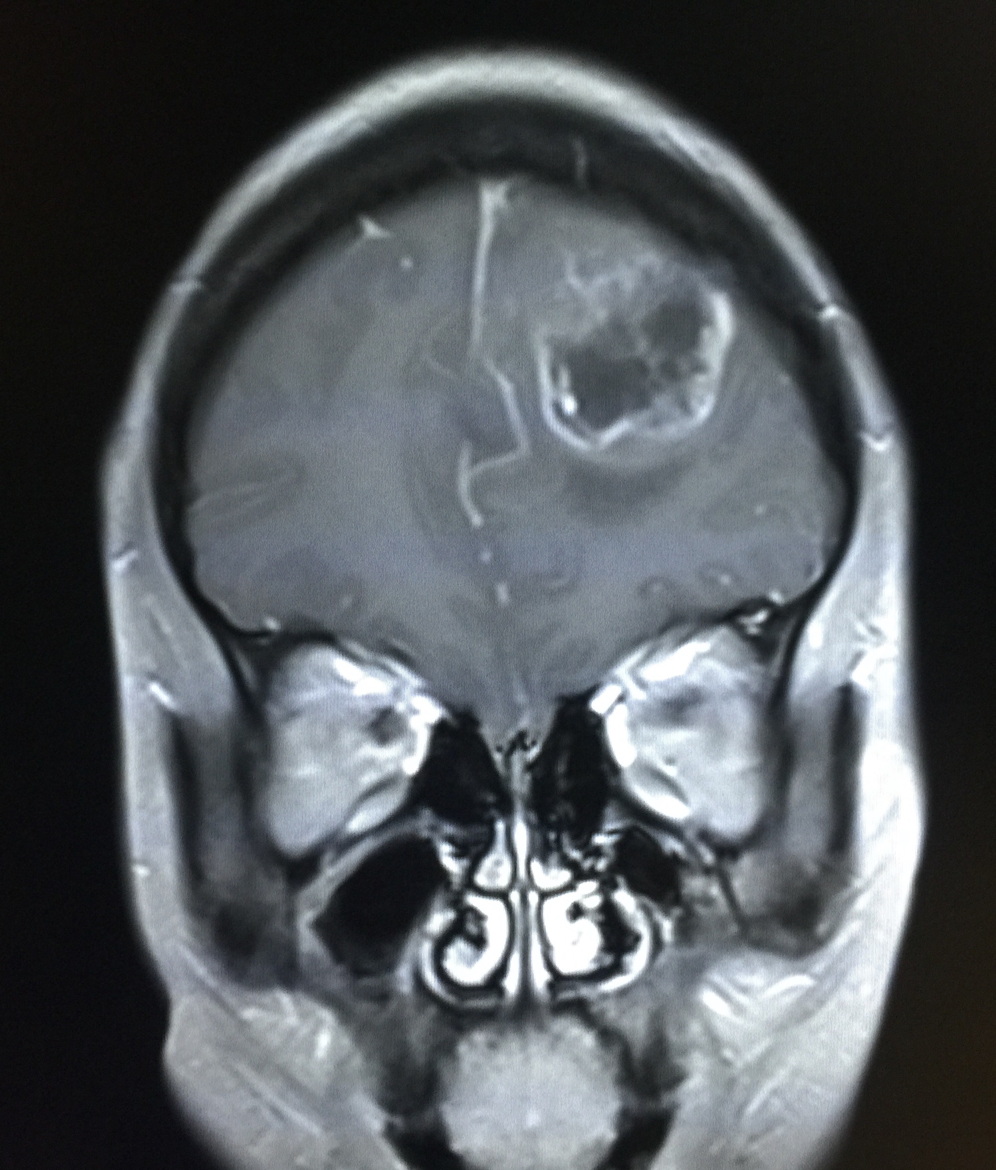 【病例】左额叶胶质母细胞瘤1例MR影像表现