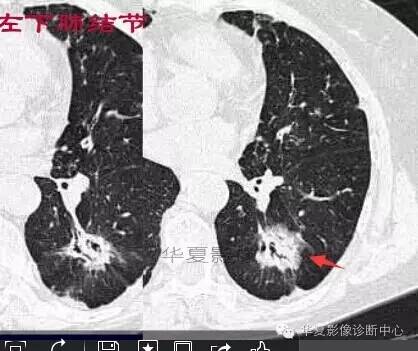 磨玻璃结节良恶性影像分析策略