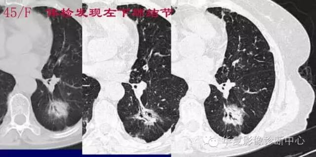 磨玻璃结节良恶性影像分析策略