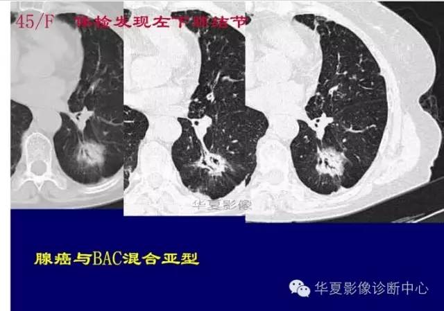 磨玻璃结节良恶性影像分析策略