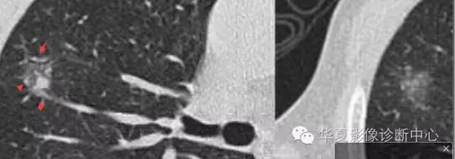 磨玻璃结节良恶性影像分析策略