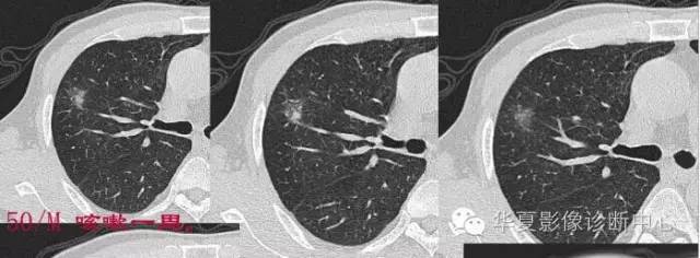 磨玻璃结节良恶性影像分析策略