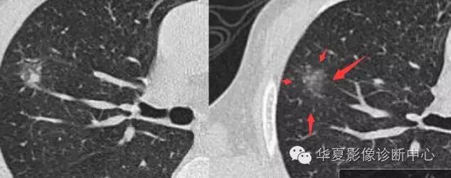 磨玻璃结节良恶性影像分析策略
