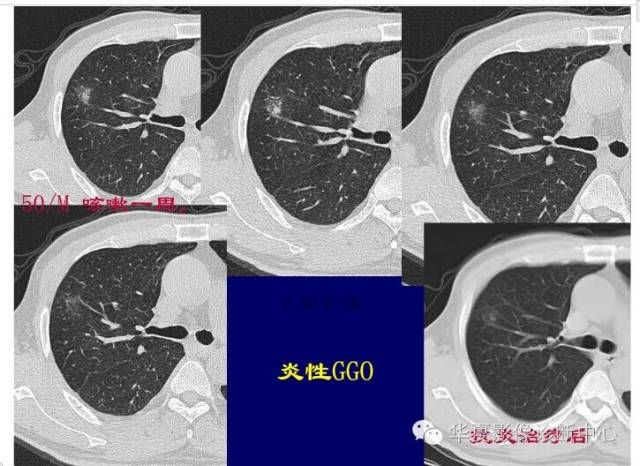 磨玻璃结节良恶性影像分析策略