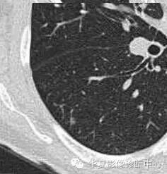 磨玻璃结节良恶性影像分析策略